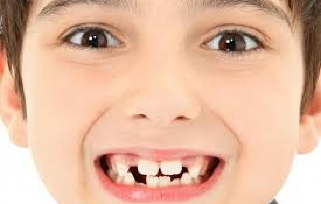 اسنان الاطفال